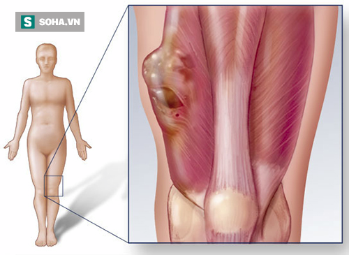 Những triệu chứng cảnh báo bệnh ung thư xương cần đi khám ngay - Ảnh 2.