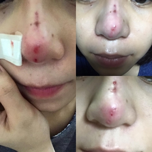 Một cô gái Sài Gòn chia sẻ trải nghiệm khủng khiếp sau khi nâng mũi bằng chỉ - Ảnh 3.