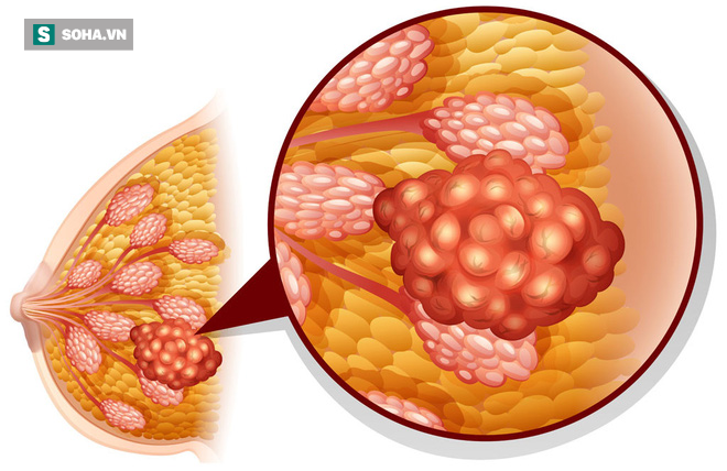 Cô gái 19 tuổi bị ung thư vú, nguyên nhân có thể khiến bạn bị sốc - Ảnh 1.