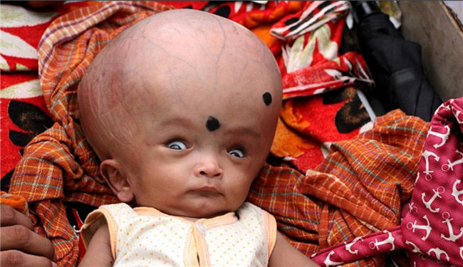 Em bé 4 tháng tuổi bị cả gia đình ruồng bỏ vì đầu quá to - Ảnh 1.