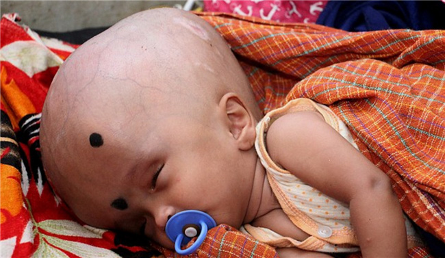 Em bé 4 tháng tuổi bị cả gia đình ruồng bỏ vì đầu quá to - Ảnh 2.
