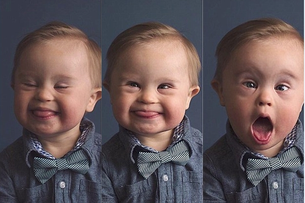 Одинаковое лицо даунов. Мальчик с синдромом Дауна. Лицо ребенка Дауна. Красивые дауны.