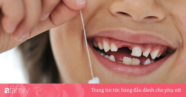Tại sao trẻ 8 tuổi bị gãy răng cửa sẽ ảnh hưởng đến sức khỏe của bạn