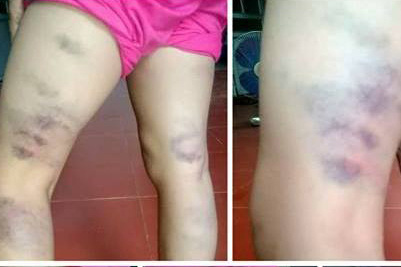 Học sinh sinh Lương Thị Anh T. bị đánh vào chân để lại nhiều vết bầm tím. Ảnh: TL