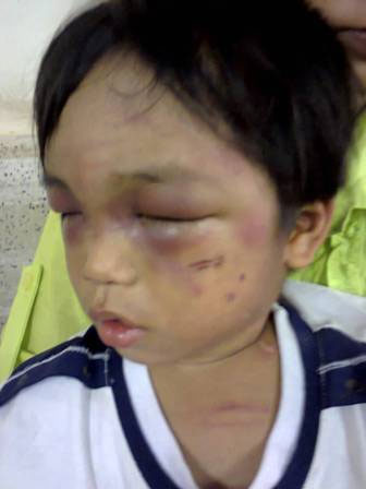 Tp.HCM: Bé trai 3 tuổi bị mẹ và cậu ruột đánh nát người, bắt đi ăn xin 1