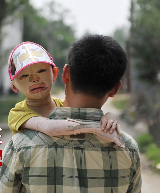 Cuộc sống đáng thương của cô bé 6 tuổi bị bỏng toàn thân 1 Cuộc sống đáng thương của cô bé 6 tuổi bị bỏng toàn thân 1