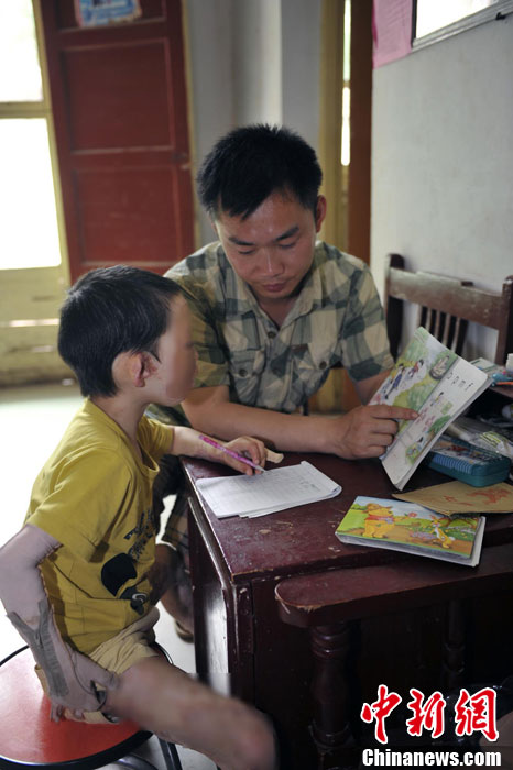 Cuộc sống đáng thương của cô bé 6 tuổi bị bỏng toàn thân 8 Cuộc sống đáng thương của cô bé 6 tuổi bị bỏng toàn thân 8