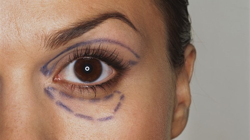 Tất tần tật về những phương pháp PTTM quanh vùng mắt 3