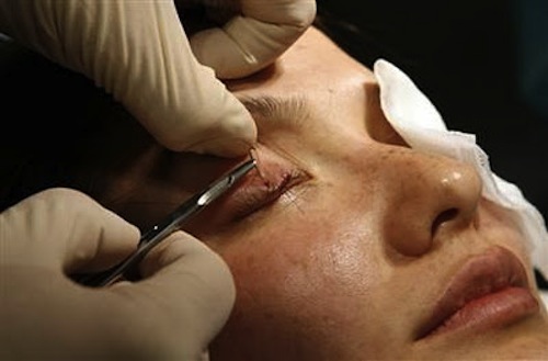 Tất tần tật về những phương pháp PTTM quanh vùng mắt 4