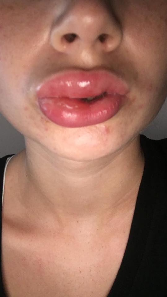  Thiếu nữ 18 tuổi sưng phồng môi vì đi làm trắng răng