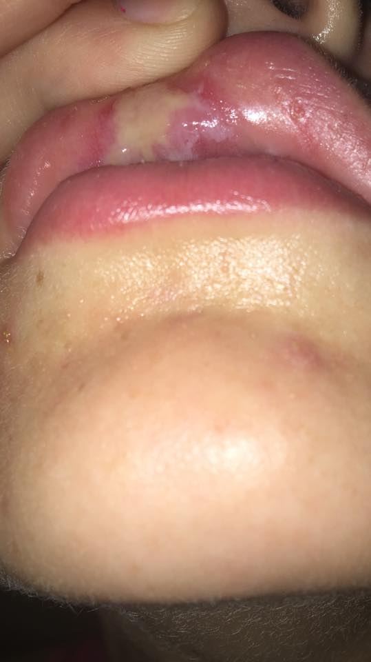 Thiếu nữ 18 tuổi sưng phồng môi vì đi làm trắng răng