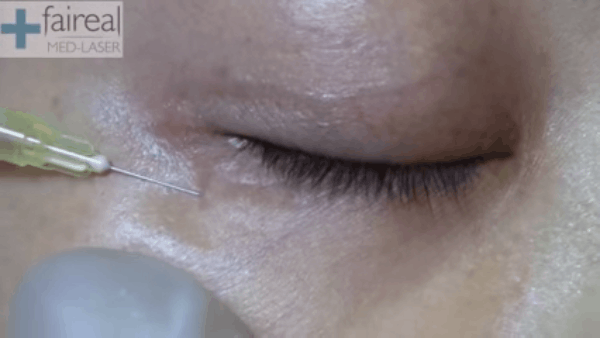 Tiêm C02 - phương pháp trị quầng thâm mắt gây sốt