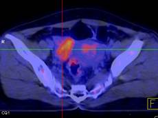 Phương pháp mới trong chẩn đoán ung thư buồng trứng 2