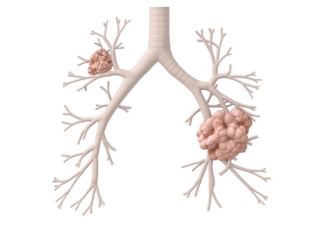 Có thể phát hiện sớm ung thư phổi qua xét nghiệm máu 3