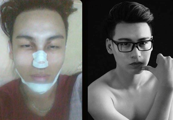 Teen boy Việt 17 tuổi công khai hình ảnh phẫu thuật thẩm mỹ 1 Teen boy Việt 17 tuổi công khai hình ảnh phẫu thuật thẩm mỹ 1