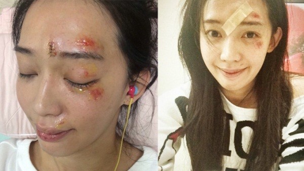 Nữ diễn viên Đài Loan công khai ảnh mặt biến dạng sau tai nạn 1
