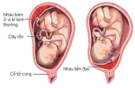 Những vị trí nhau thai đặc biệt mà mẹ bầu cần lưu ý 3