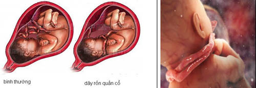 Những điều mẹ bầu nên biết về tràng hoa quấn cổ 1