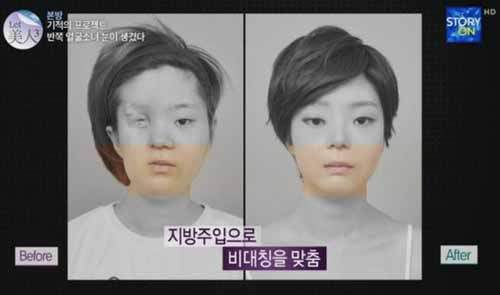 Giật mình gương mặt của cô gái sau phẫu thuật thẩm mỹ 8