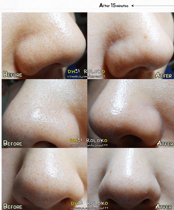 mụn đầu đen mụn đầu đen