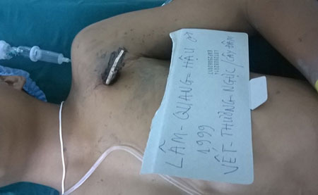TP.HCM: Một học sinh ngã xuống ao, bị cọc đâm xuyên ngực 1
