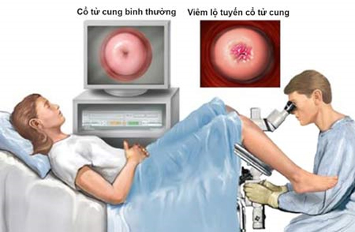 viêm lộ tuyến cổ tử cung