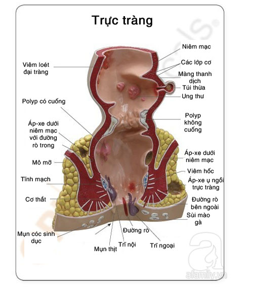 rắc rối ở hậu môn