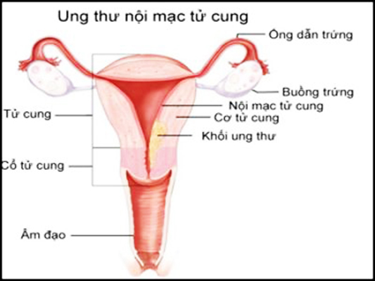 viêm nội mạc tử cung