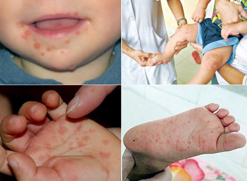 bệnh tay chân miệng vào mùa bệnh tay chân miệng vào mùa