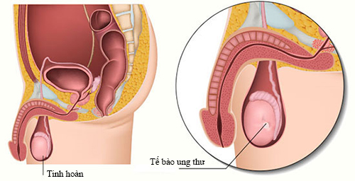 phòng ngừa ung thư