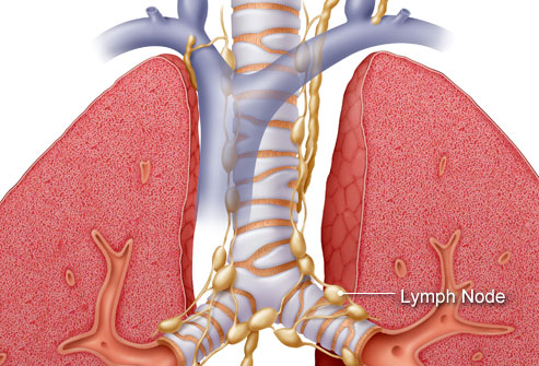 Làm thế nào để phát hiện và điều trị bệnh ung thư phổi? 6