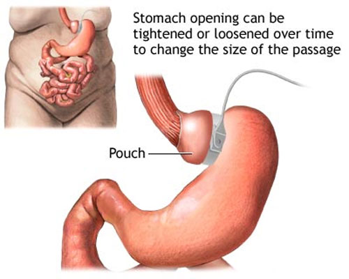 Thắt đai dạ dày giảm béo: hiệu quả gấp 10 lần phương pháp khác 1