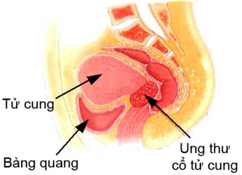 Chia sẻ về cách vượt qua bệnh ung thư cổ tử cung  1