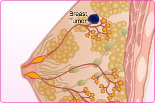 Nhận biết các giai đoạn phát triển của bệnh ung thư vú 2