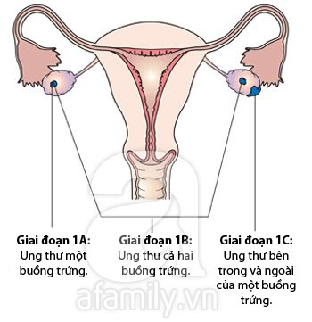 Hình ảnh về các giai đoạn phát triển của ung thư buồng trứng 1