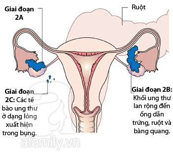 Hình ảnh về các giai đoạn phát triển của ung thư buồng trứng 2