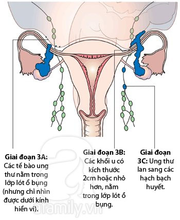 Hình ảnh về các giai đoạn phát triển của ung thư buồng trứng 3