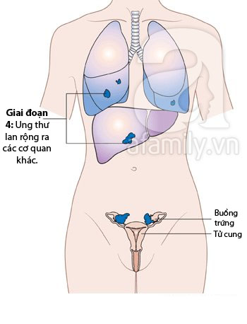 Hình ảnh về các giai đoạn phát triển của ung thư buồng trứng 4