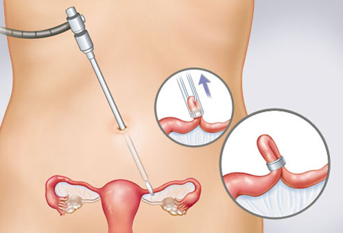 Hình ảnh sinh động về các biện pháp tránh thai ở nữ giới