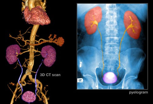 Những hình ảnh rõ nét về bệnh ung thư bàng quang 4