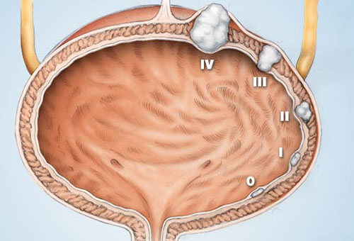 Những hình ảnh rõ nét về bệnh ung thư bàng quang 6