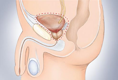 Những hình ảnh rõ nét về bệnh ung thư bàng quang 7