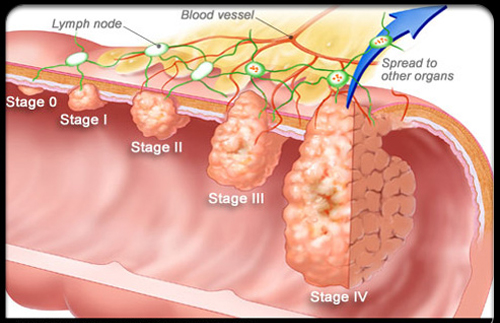 Những điều quan trọng bạn cần biết về ung thư ruột già 6