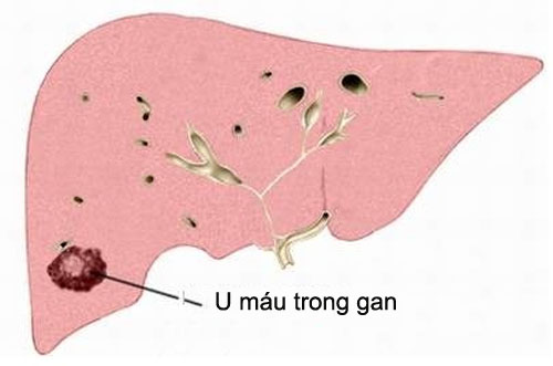 Hiểu đúng về bệnh u máu trong gan 1