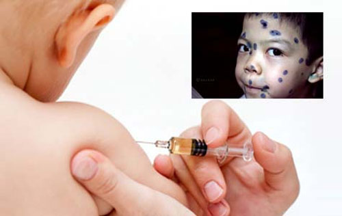 Cảnh giác với bệnh thủy đậu đang gia tăng 1 Cảnh giác với bệnh thủy đậu đang gia tăng 1