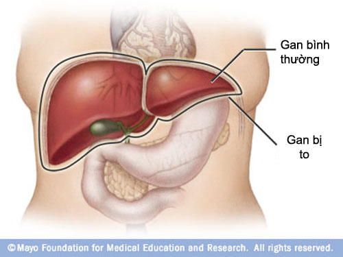 Những dấu hiệu chứng tỏ bạn bị tổn thương gan 2