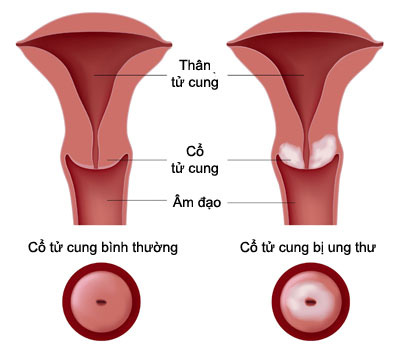 Một vài triệu chứng nhận biết ung thư cổ tử cung 1