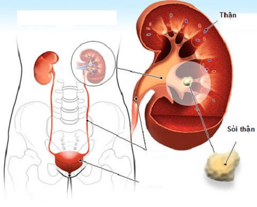 Tất cả những điều bạn cần biết về bệnh sỏi thận 1