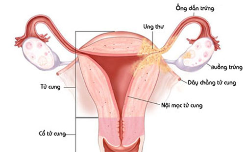 Top 5 nguyên nhân gây ra cục máu đông trong ngày 