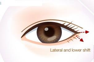 Tạo dáng to tròn cho đôi mắt gần nhau bằng phẫu thuật mở rộng đuôi mắt 5
